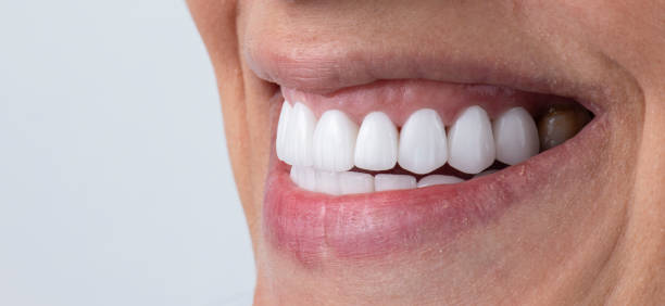 The picture provides a close-up of a person’s mouth and chin as they smile.