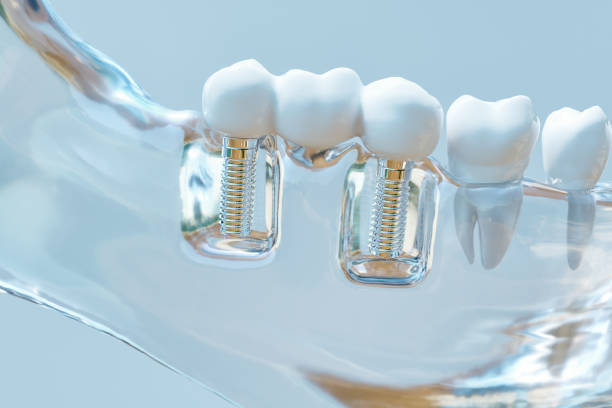 A clear plastic model of dental implants set in a jaw bone.